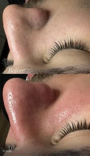 Before and after nose treatment